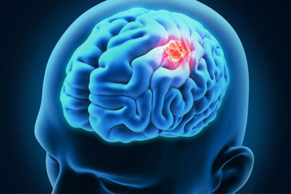 Brain-cancer